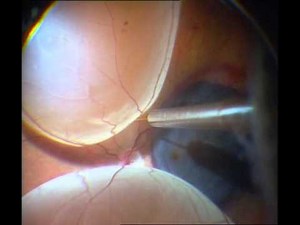 Macular Translocation • Video • MEDtube.net