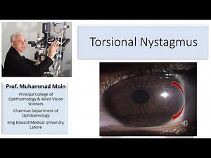 Torsional Nystagmus