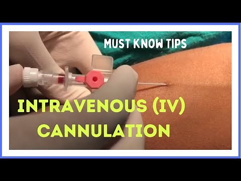 How to Insert a Cannula