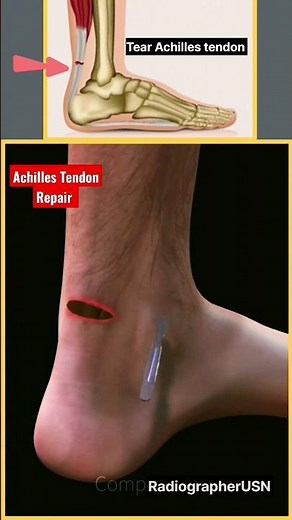 Calcaneal-Achilles Tendon Repair | 3d Animation | Ankle Injury #shorts