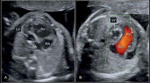 First-Ever Genes Discovered to Cause Rare Congenital Heart Defect | Cardiology