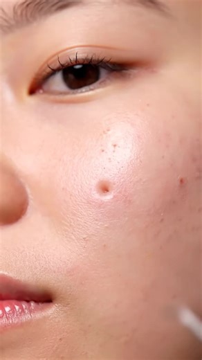 pimples Remove (@pimples.remove3)’s videos with original sound - pimples Remove