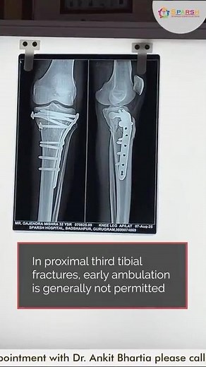 Recovery after proximal third tibia fracture #proximaltibiafracture #drankitbhartia