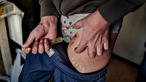 What Happens To Your Body When You Do Krokodil, The "Zombie Drug"