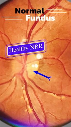 Normal fundus | Smartphone Fundus Videography | Fundus Photography | Short Video 498