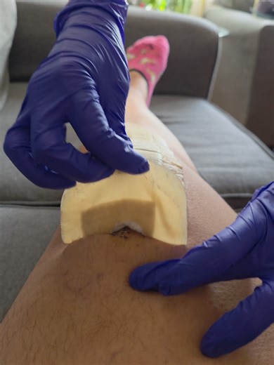 Total Knee Replacement: 2 Weeks Post-Op Recovery