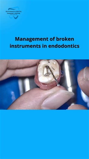 Dr Ronald on Instagram: "The Management of Broken Instruments in Endodontics workshop was successfully conducted at Dr. Ronald’s Dental Training Centre, Bengaluru, focusing on one of the most critical challenges in clinical endodontic practice. This advanced, hands-on training covered causes of instrument separation, diagnosis, decision-making protocols, and predictable techniques for retrieval and bypassing fractured instruments. Participants gained practical exposure to magnification-based str