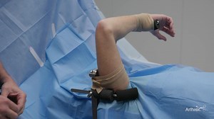 ElbowLOC® Arm Positioning System—Supine Positioner Assembly