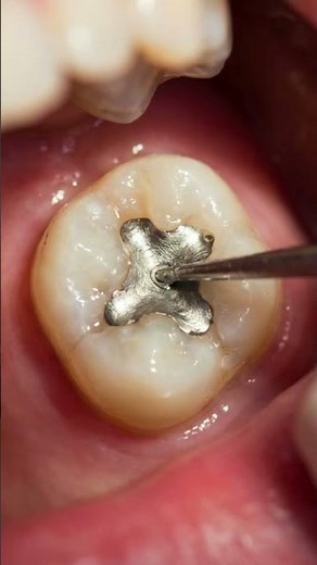 Tooth Filling Procedure Step by Step | Dentist Repairing Cavity (Close-Up)