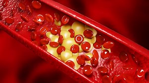 Understanding The Risk Of Calcium Buildup In Your Arteries: Warning Signs To Note