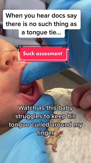 Understanding Frenectomy for Tongue and Lip Tie in Babies