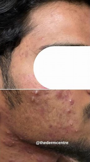 Acne conglobata (AC) #thedermcentre #cosmeticdermatology
