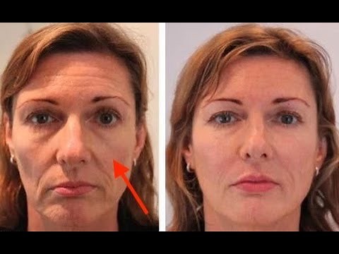 How Cheek Filler unlocks the mid face in minutes