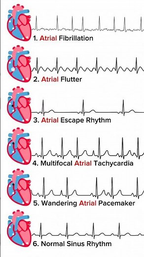 ECG changes in Atrial Arrhythmias explained #ecg #ecginterpretation #cardiology