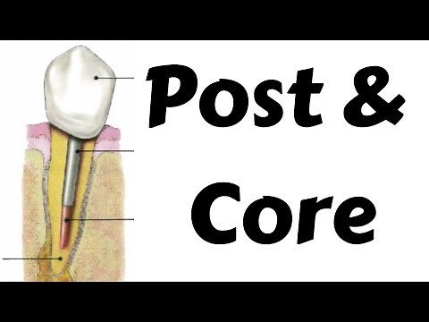 Post & Core post preparation procedure in endodontic & prosthodontics- Step by step Dentsply calibra
