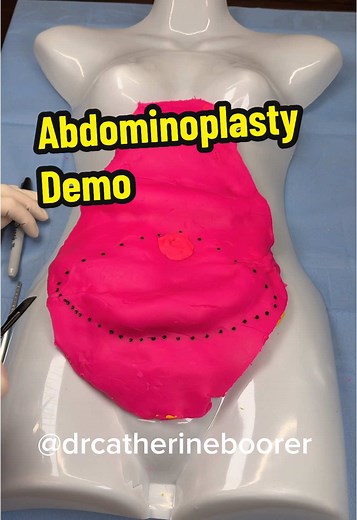 Abdominoplasty: Preserving Your Belly Button During Surgery