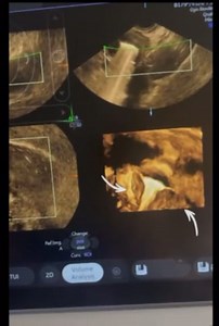 ExEm® Foam / HyFoSy 3D rendered image