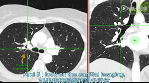 Chest CT- Bronchopulmonary Segments
