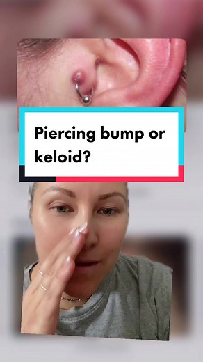 I can’t believe we haven’t covered the difference between piercing bumps and keloids yet on our channel! #thecuratedlobe #earpiercings #piercing #piercingbump #keloid