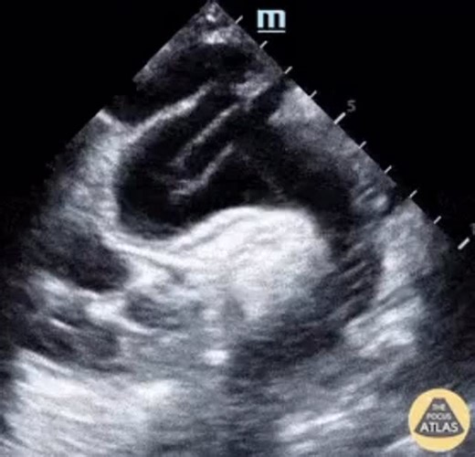 Abhilash Koratala on Instagram: "Illustrative #POCUS image: Suprasternal notch view of aortic dissection. Courtesy: Michael Cover, MD. TPA. #POCUS #FOAMed #MedEd #Medicalstudent #internalmedicine #internalmedicineresidency #criticalcaremedicine #emergencymedicine #echocardiography"
