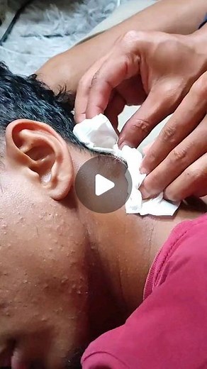 jonathancantalk2 | Wait and see 🙄🙄🙄 - - #skincareroutine #acne #cystremoval #zit #popping #popper #extraction | Instagram