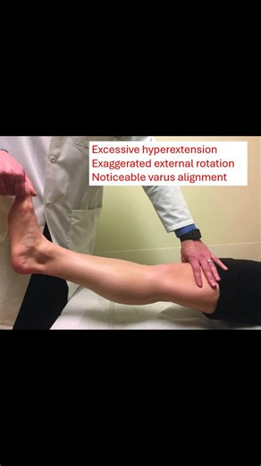 The external rotation recurvatum test evaluates for posterolateral corner injuries. With the patient supine, the examiner applies a downward force over the suprapatellar region. At the same time, the examiner lifts the patient’s great toe off the table and externally rotates the tibia. A positive test is indicated by excessive hyperextension, exaggerated external rotation of the tibia, and a noticeable varus alignment of the tibia. Sensitivity ranges from 7% to 30%! Read: https://wikism.org/Exte