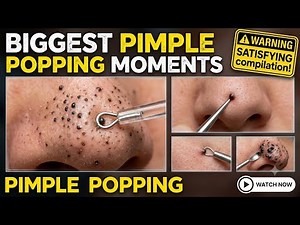 Biggest Pimple Popping Moments | Blackhead Removal Compilation