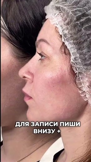 Morpheus 8: 1-Day Lift for Years 🔥 Certified InMode Device. Microneedling + Radiofrequency