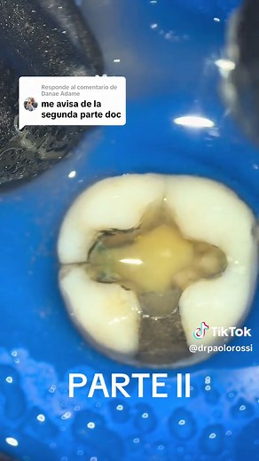 Understanding Amalgam Dental: Detailed Explanation