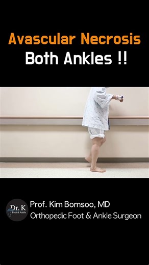 Talus AVN (Both Ankles) → (One Surgery) Custom Titanium Talus Replacement #TalusAVN #3DTalus