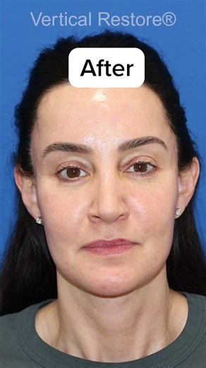 Facelift Before & After Transformation - Jawline & Skin Transformed in 4 Months