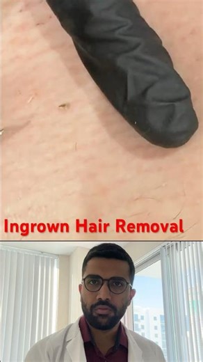 Ingrown hair removal explained #fyp #ingrownhairremoval