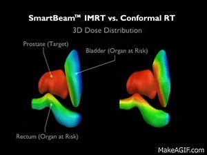 Intensity Modulated Radiation Therapy (IMRT) on Make a GIF
