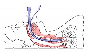 Rapid sequence induction - Alchetron, the free social encyclopedia