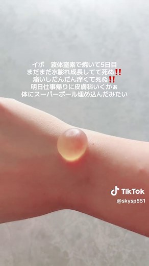 イボの液体窒素治療の経過報告