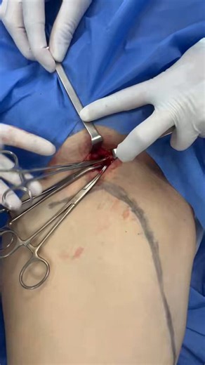 Dr Luis Felipe Cabrera Vargas MD FACS (@PipeCabreraV) on X