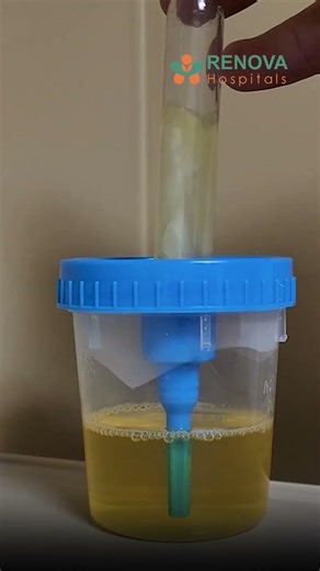 Urine Taste చేసి వ్యాధి తెలుసుకోవచ్చా? |Dr .N.P Padmakar Sr consultant urologist| Renova Hospitals