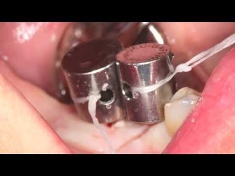 MD Guide - 2:1 Pilot Drill + Surgical Guide, 3 dental implants - Physics Forceps