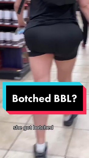 #stitch with @mailynhnguyen Botched BBL or normal shaped behind? #bbl #botched #buttenhancement #plasticsurgeon