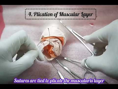 Delorme's Procedure - Rectal Prolapse surgery