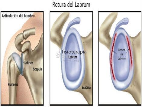Rodete o labrum glenoideo