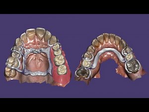 Modélisation 2 châssis numérique avec exocad