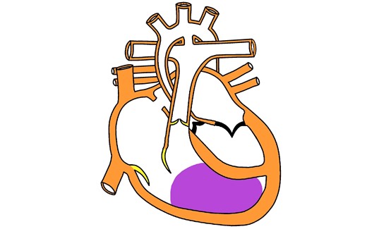 Hypoplastic Left Heart Syndrome (HLHS)