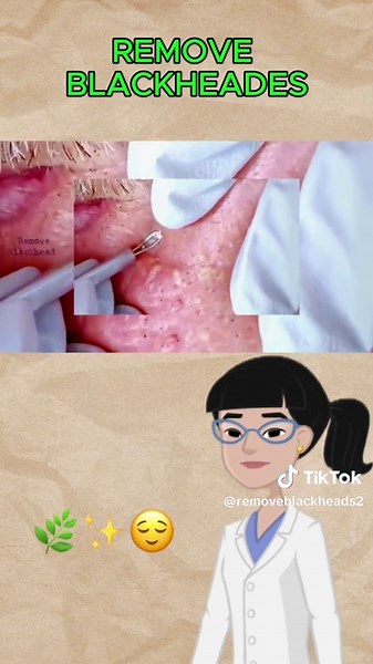#remove #blackhads #removeblackhead #nose