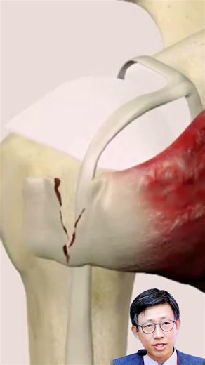 Shoulder Pain? Check Your Biceps Tendon!