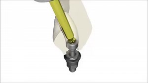 ELSNER SYSTEM Welcome to the new world - VARIO TUBE Using this solution extends the capability of screw-retained Crowns and bridges even in cases of below-optimal implant positions. It also enables the dental restoration to be removable -in a non-destructive manner- even years later. | Elsner System Ltd