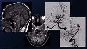 #215: Recurrent Giant Basilar Apex Aneurysm after Coiling and Flow Diversion Treated with Thrombectomy and Complex Clipping - Aneurysm - Seven Series Collection