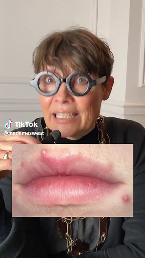 How to tell the difference between a cold sore & a pimple 👄 #coldsore #coldsores #coldsorehacks #pimple #acne #pimples #lippimple #howto #howtotiktok #mouth #lips #difference #contagious #hsv #hsv1