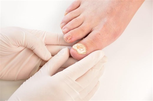 how to get rid of toenail fungus with bleach
