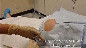 Lo sapevi che si possono drenare fino a 6 litri di liquidi dal peritoneo eseguendo una singola paracentesi❓ 🔎 Per paracentesi (o peritoneocentesi) si intende la rimozione di liquido ascitico dalla cavità peritoneale. 🚨 Due sono i motivi per cui può essere necessario rimuovere il liquido dall’addome: analizzarlo (esplorativa) o ridurre la pressione endoaddominale (evacuativa) 📌 La procedura prevede la puntura dell’addome (solitamente la regione del fianco sinistro), in condizioni di sterilità,